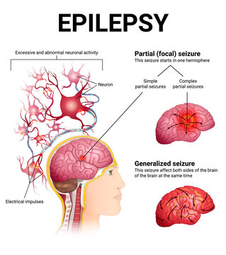 types of epileptic seizures, brain and neurons