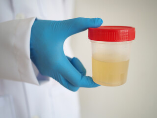 Medical urine test on white background. closeup photo, blurred.