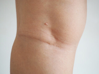 Fototapeta na wymiar Closeup blurred, mole of skin lesion cause of proliferation of pigment derma cells and melanocytic pigmented naevus on the woman leg.