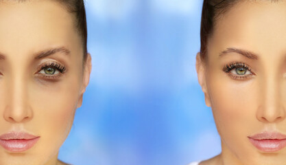 Lower eyelid blepharoplasty.Upper  blepharoplasty.Before and after cosmetic procedures