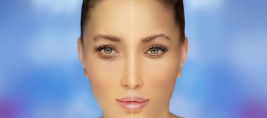Lower eyelid blepharoplasty.Upper  blepharoplasty.Before and after cosmetic procedures