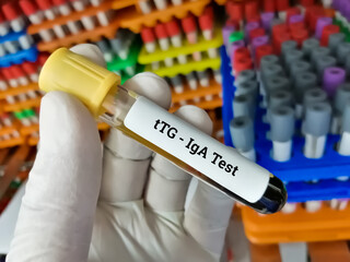 Blood Sample for Tissue transglutaminase antibody (tTG) IgA, diagnosis of celiac disease