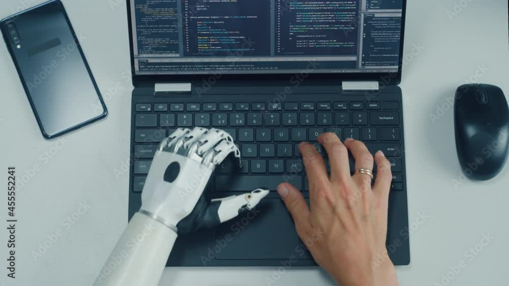 Poster Aerial Top Down View: Professional Programmer with Disability Using Prosthetic Arm to Work on Laptop Computer. Specialist Swift and Natural Use of Myoelectric Bionic Hand To Type Code for Software