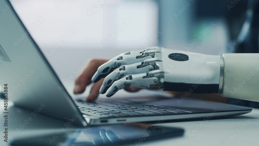 Poster Close-up on Hands: Person with Disability Using Prosthetic Arm to Work on Laptop Computer. Specialist Swift and Natural Use of Thought Controlled Body Powered Myoelectric Bionic Hand.