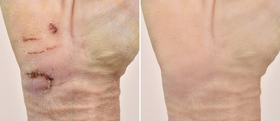 Injured hand of a woman before and after recovery and medical treatment. Close-up. Medical concept.