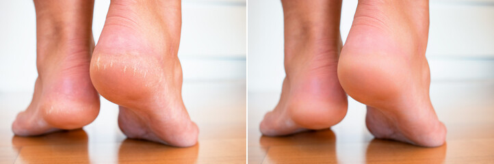 Before and after foot care. Concept of feet healthcare, foot bath and removal of cracked heels....