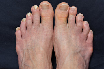 Closeup of two caucasian feet, one with mycosis, fungal nail infection, side by side comparison,...