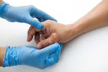 Doctor holding needle trying to pop blister on sore hand and thumb. Nurse with gloves attending a...