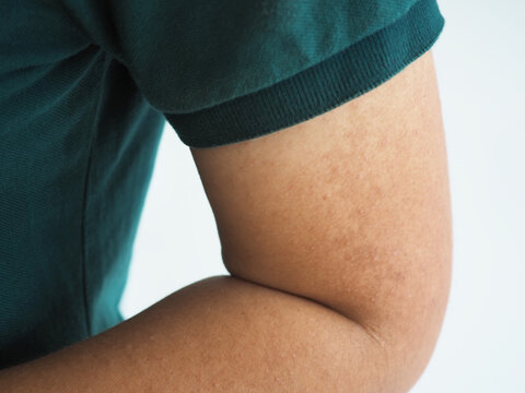 Asian woman had dark brow birthmarks on her arms near her elbows. closeup photo, blurred.