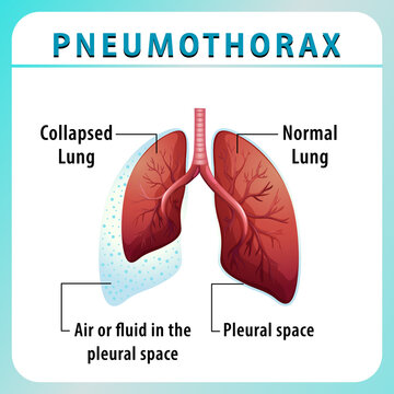 Pneumothorax diagram with collapsed lung and normal lung