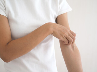 Asian woman itching and scratching on arm from itchy dry skin eczema dermatitis. closeup photo, blurred.