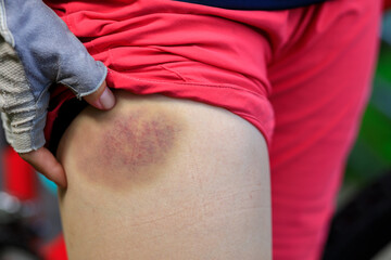 People with bruised leg casused by bike accident