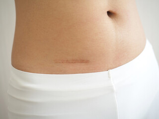 Fototapeta na wymiar Scar on woman's stomach from appendectomy. closeup photo, blurred.