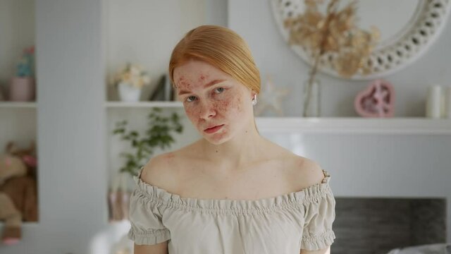 Young Redhead Girl with Problem Skin Looks at the Camera Like in a Mirror. Acne treatment stages - 3rd day of 28. Commercial ready woman skin care concept.
