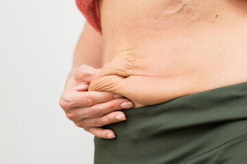 stretched skin on the abdomen after losing weight