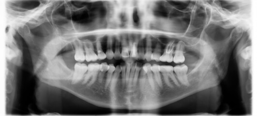 X-ray dental image.