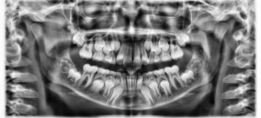 X-ray dental image.