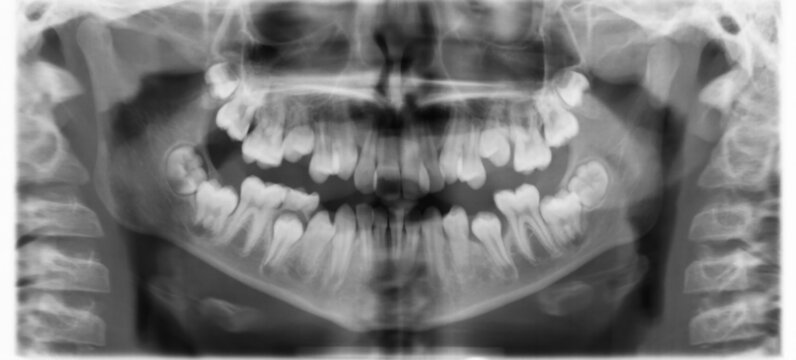 X-ray dental image.