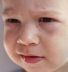 Fototapeta premium Health, dermatology, pediatrics, disease dermatitis concepts - close-up of face small baby child with sick dry skin rash on cheeks. Food allergy flour products, gluten intolerance reduced immunity