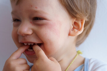 Health, dermatology, pediatrics, disease dermatitis concepts - close-up of face small baby child with sick dry skin rash on cheeks. Food allergy flour products, gluten intolerance reduced immunity