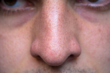 Detail of human nose and nostrils with under eye circles. White skin.