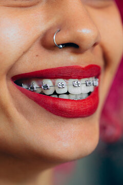 Profile of smiling woman with braces