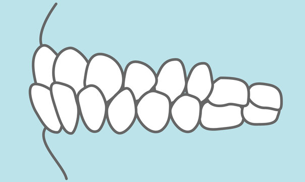 歯並びのイラスト