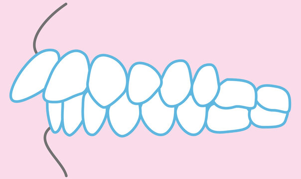 歯並びのイラスト