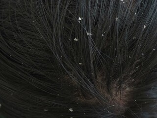 Dandruff on woman's hair. closeup photo, blurred.