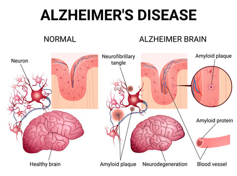 Alzheimer disease and changes in the brain