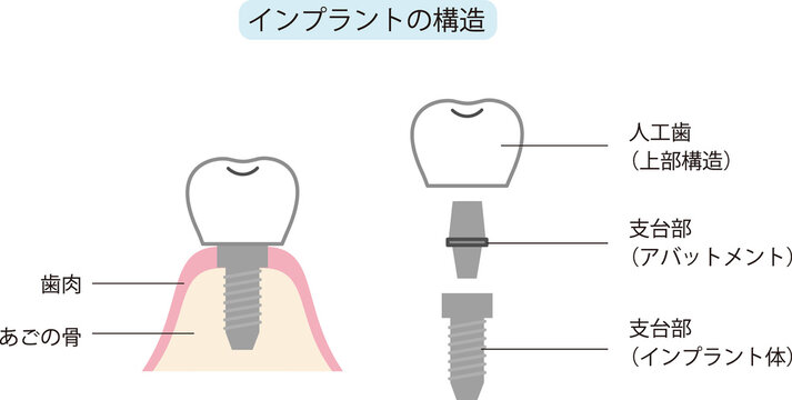 338 Best Dental Implant Diagram Images Stock Photos Vectors Adobe Stock 338 Best Dental Implant Diagram Images Stock Photos Vectors Adobe Stock