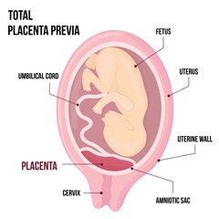 Fototapeta premium Total Placental previa. Dangerous Placenta Location During Pregnancy. Medical Pathology. detailed medical diagram with table of symbols.