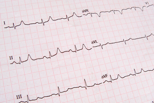 ECG graph recording an elderly patient's heart condition. Graph printout showing the result of an adult person's electrocardiogram (EKG) after medical test. Closeup top view.