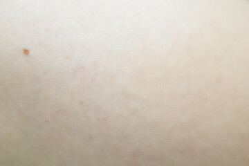 Fototapeta premium close-up of the skin after using an ultrasound machine to remove cellulite in problem areas