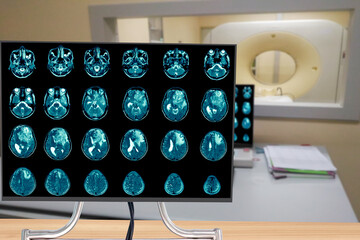 Magnetic resonance imaging Finding  5 cm isodense mass with ill-defined margin and surrounding edema at Left frontal lobe. Glioblastoma, brain metastasis.science and education mri brain background.