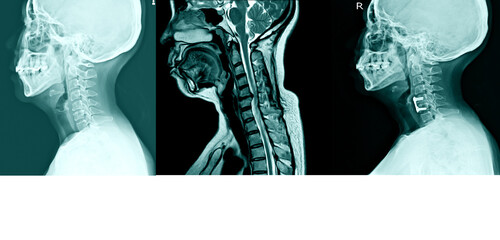 X-ray C- Spines and MRI scan of a patient with chronic upper extremities weakness showing herniated...