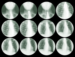 Collection step swallowing test Esophagogram(Barium Sulfate (BaSO4) ),Medical image concept.