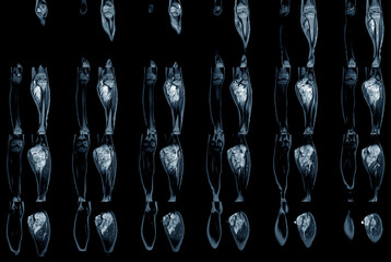 Magnetic Resonance Imaging (MRI) lower extremity both legs  showing tumor or mass at leg...