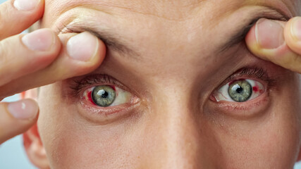 close-up of a man with red sore eyes raising eyelids with fingers looking at the camera.