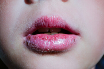 Angular cheilitis close up of chapped, cracked lips caused wound on the corner of the lips: dry...