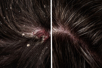 Before and after dandruff treatment shampoo on hair woman. Dandruff in the hair. Flaky scalp. Seborrhea. - obrazy, fototapety, plakaty