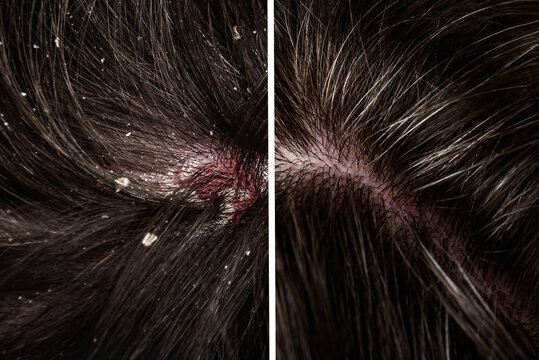 Before and after dandruff treatment shampoo on hair woman. Dandruff in the hair. Flaky scalp. Seborrhea.