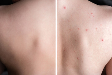 Before and after treatment acne pimples on skin back of teenager.