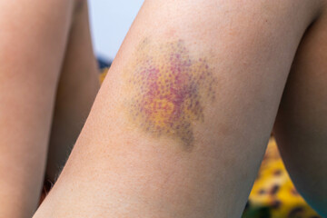 Hematoma on the leg. Large hematoma, close-up shot.