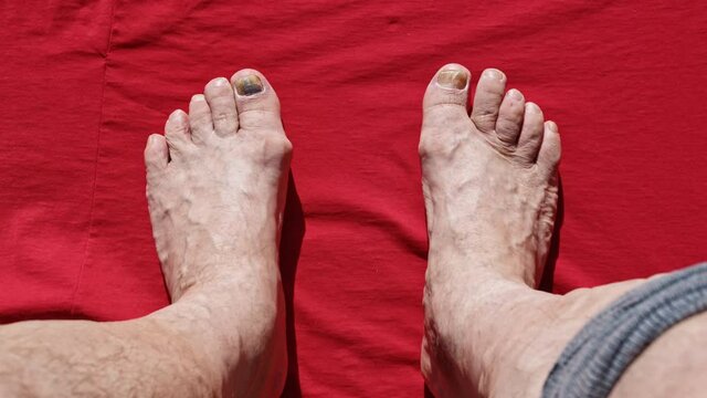 Feet of old man on red surface. Elderly person legs diseases, problems, fungus, varicose veins, pain, discomfort. Mutilated crippled nails. Dermatology, phlebology, podiatry, chiropody, pedicure