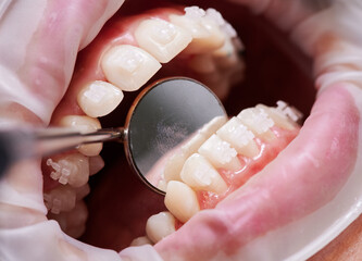 Close up of orthodontist checking patient teeth and braces with dental mirror. Person with cheek...