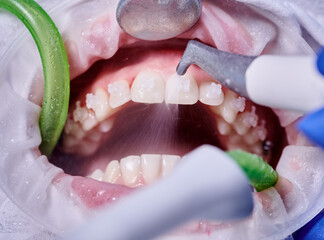 Close up of orthodontist using dental tools while cleaning teeth of patient. Woman with cheek...