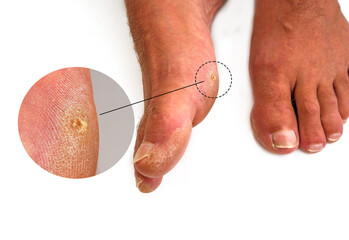 Close up a callus on man's foot. Callus is common foot problem by a toughened skin become relatively thick and hard in response to repeated friction, pressure, or other irritation isolated on white.