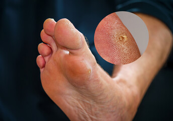 Close up hard skin on man foot. Skin problem foot callus or soft Corn on the side of man's foot....