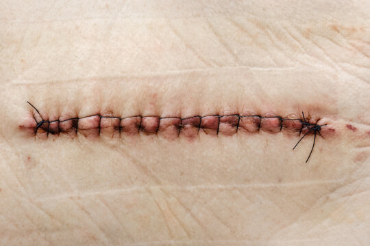 Postoperative suture on human skin